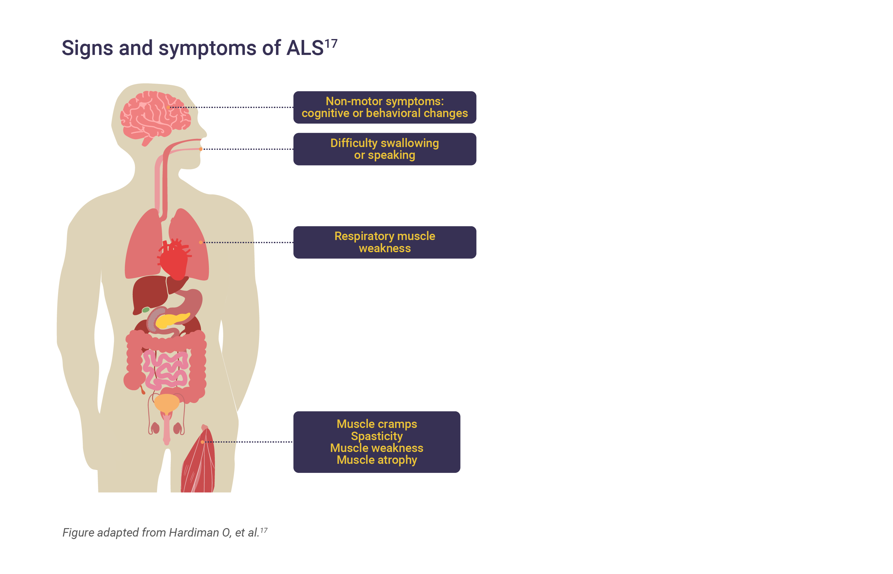 Signs and symptoms of ALS