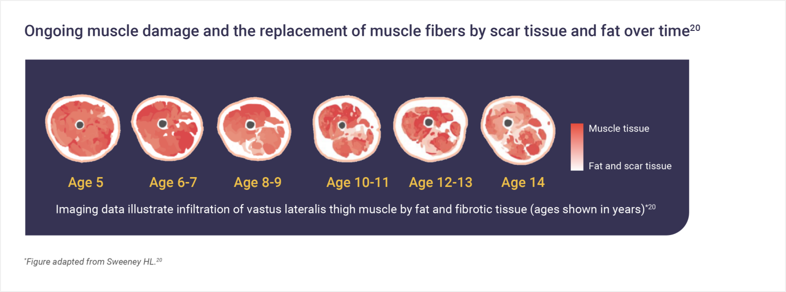 Infographic: Ongoing muscle damage and the replacement of muscle fibers by scar tissue and fat over time