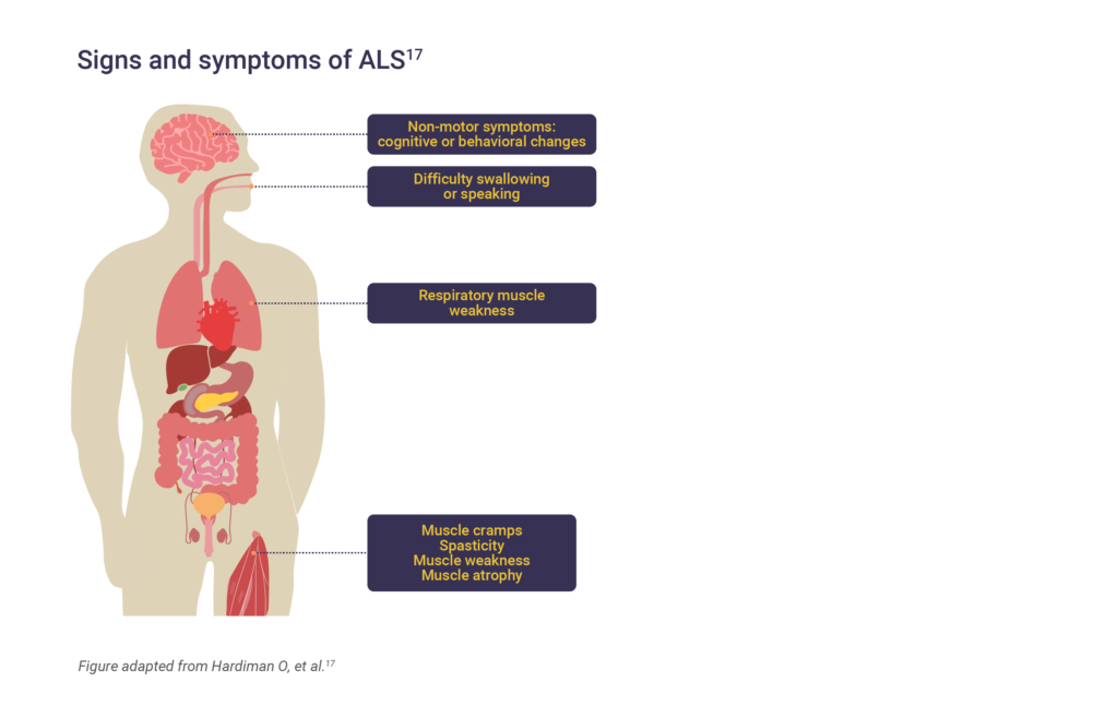 Amyotrophic Lateral Sclerosis Als Medhub 4792